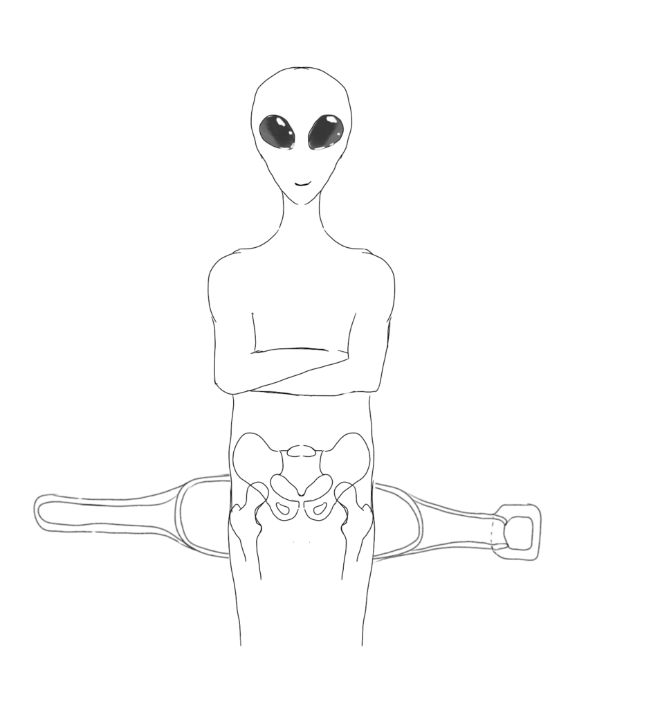 Alien con una fronda pélvica en los trocánteres mayores